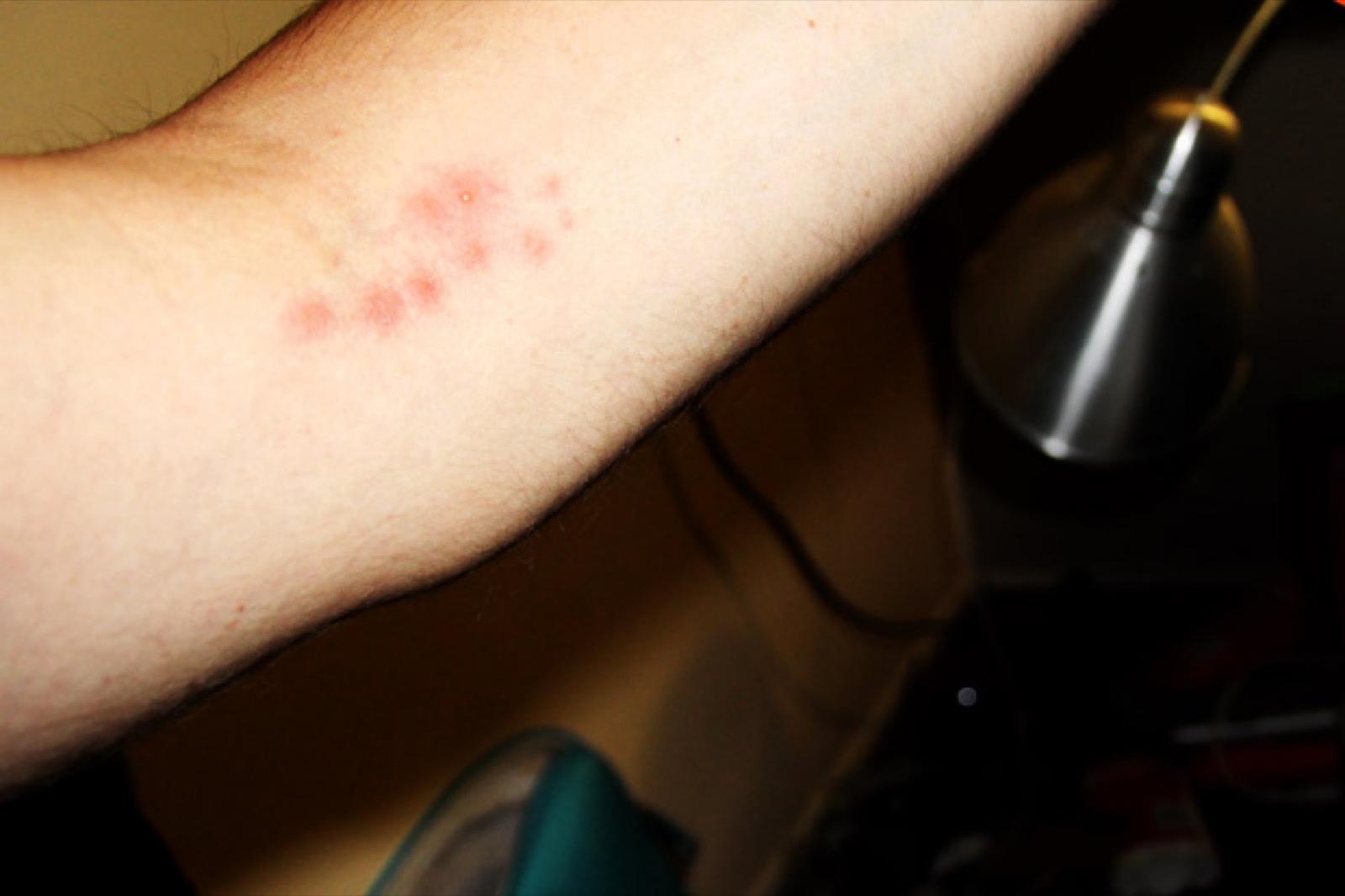 Bed Bug Bites